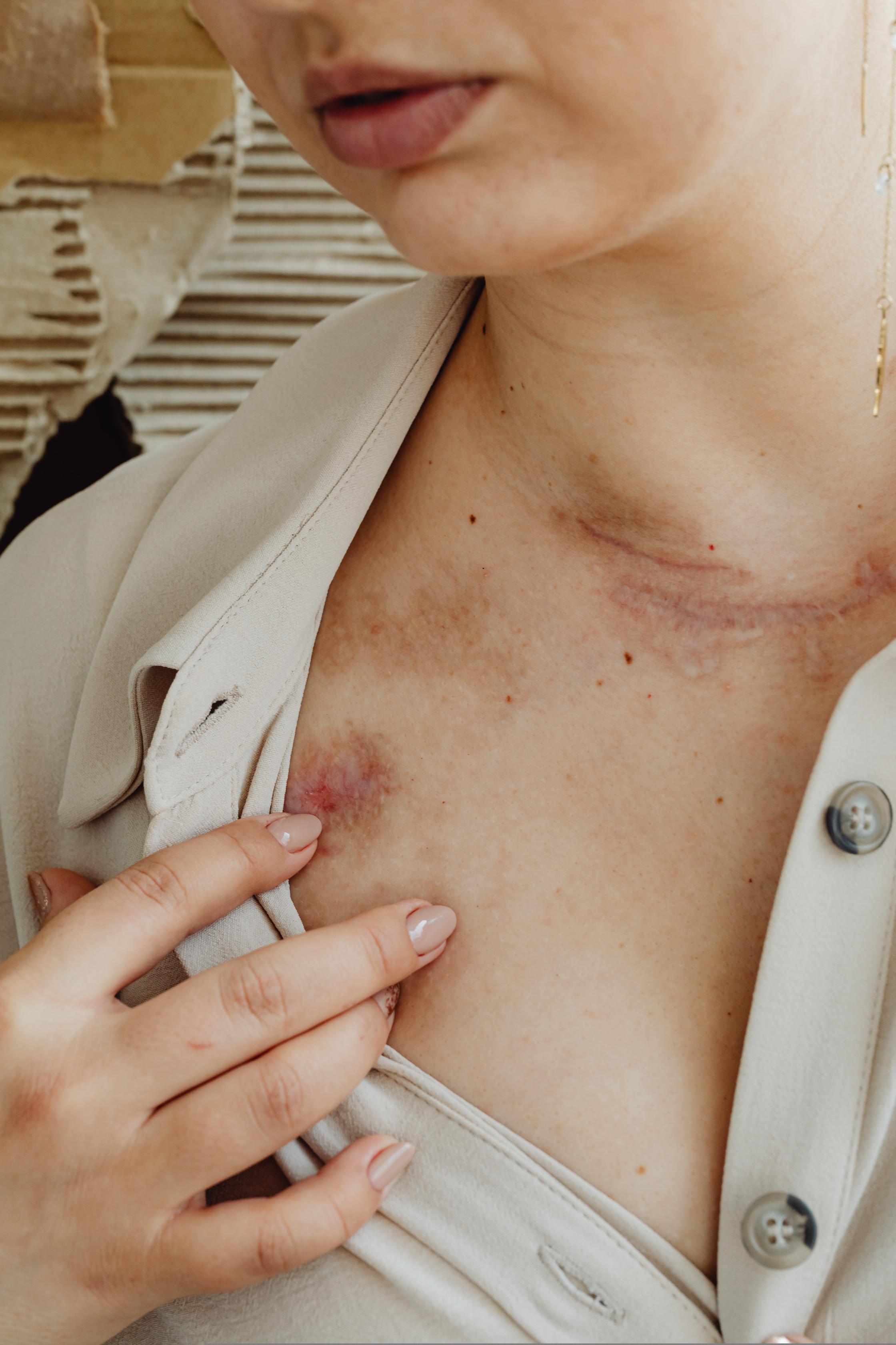 Causes of chest scars in women